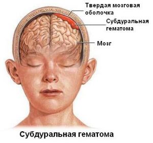 Гематома на голове