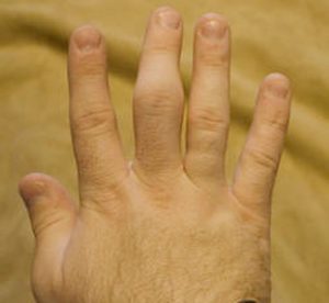 Перелом пальца