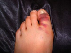 перелом-пальца-на-ноге1
