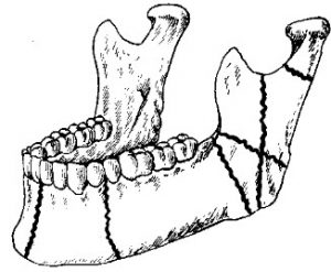 переломы-нижней-челюсти1