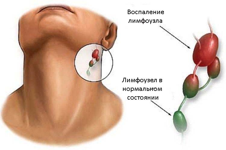 Лимфоузлы под челюстью схема как лечить воспаление