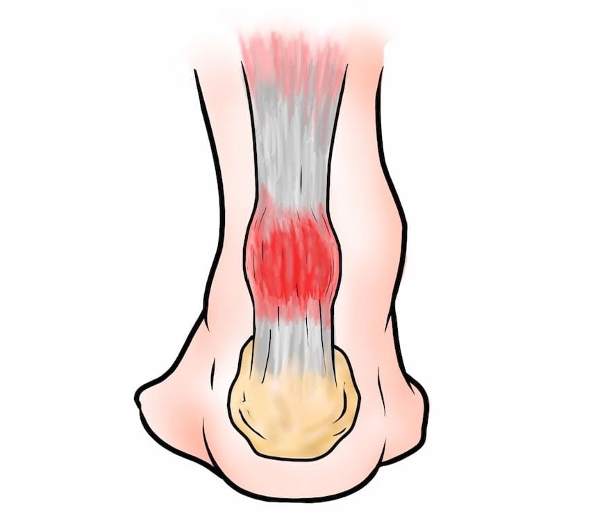 Тендинит ахиллова сухожилия — лечение и симптомы, как лечить ...