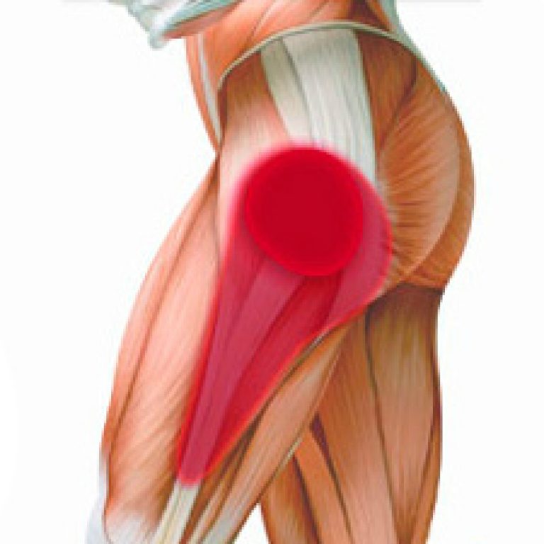 Приводящие мышцы бедра триггерные точки