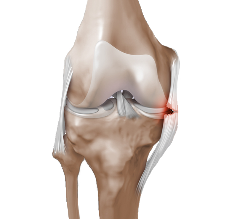 Повреждены связки коленного сустава симптомы и лечение фото
