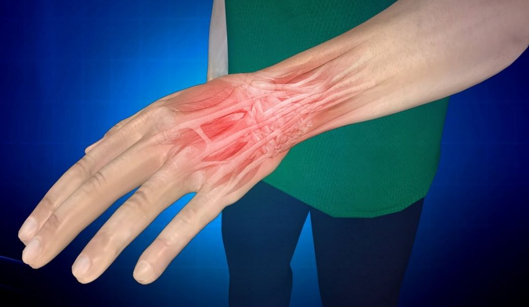 Растяжение связок кисти руки — симптомы и лечение в домашних условиях ...