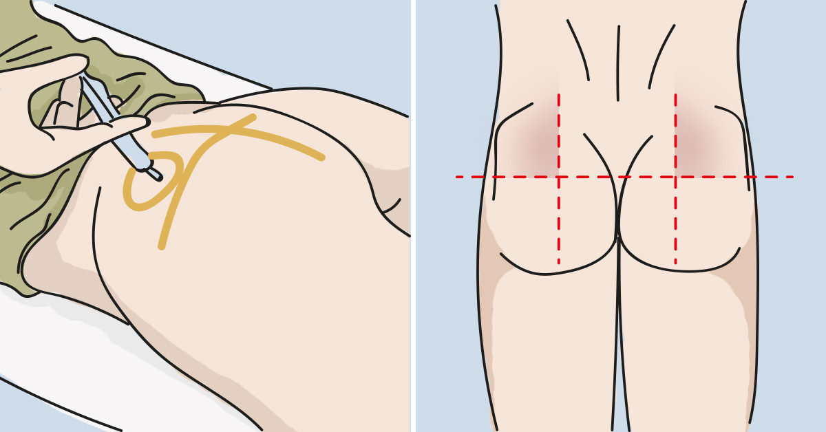 Место укола в ягодицу фото взрослому